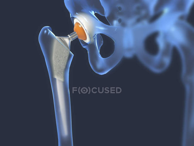Implante de reemplazo de cadera, ilustración digital médica . - foto de stock