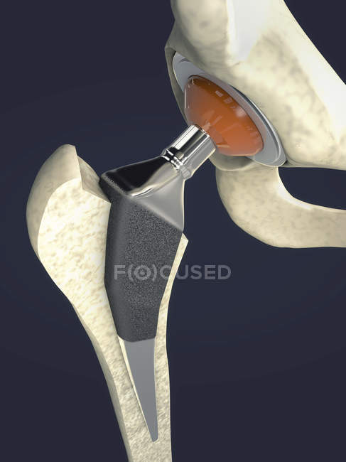 Hip replacement implant, medical digital illustration. — Stock Photo