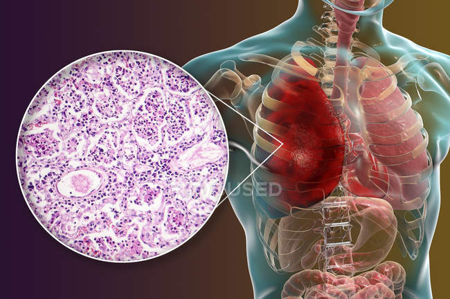 Pneumonie lobaire au stade de l'hépatisation rouge, illustration numérique et micrographie photonique . — Photo de stock