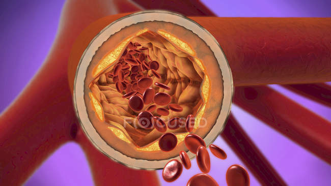 Ilustración digital 3d del vaso sanguíneo estrechado
. - foto de stock