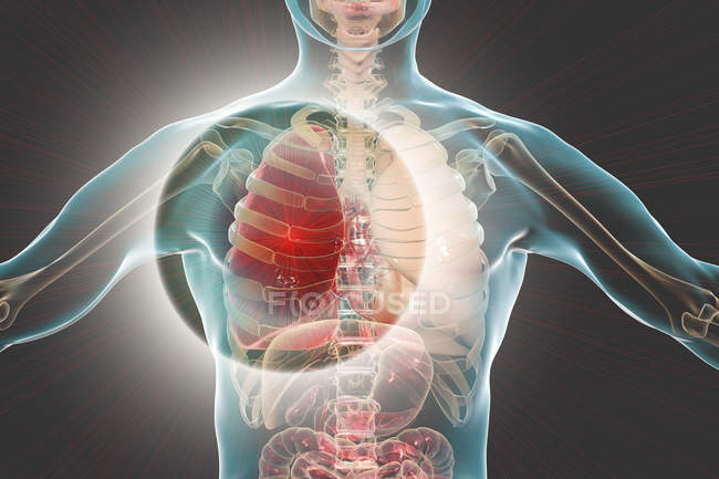 Lobar pneumonia in stage of red hepatisation, conceptual digital illustration. — Stock Photo
