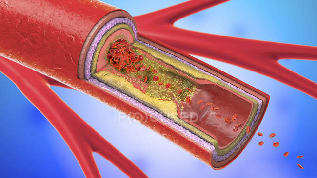 Illustration numérique 3D d'un vaisseau sanguin rétréci . — Photo de stock
