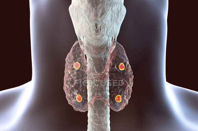 Illustration numérique des glandes parathyroïdes rouges accentuées situées derrière la glande thyroïde en silhouette humaine . — Photo de stock