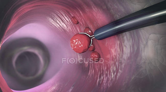 Illustration of removal of colonic polyp with electrical wire loop during colonoscopy. — Stock Photo