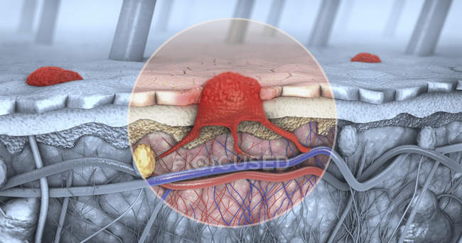 Illustration 3D d'une coupe transversale de la peau avec mélanome dans la circulation sanguine et les voies lymphatiques
. — Photo de stock