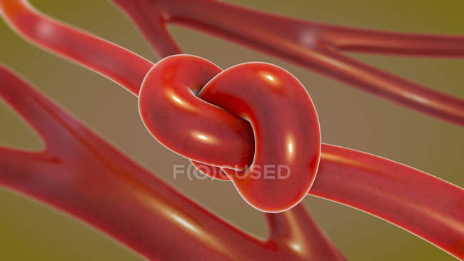 3D Illustration des Blutknotens in Arteriengefäßen. — Stockfoto