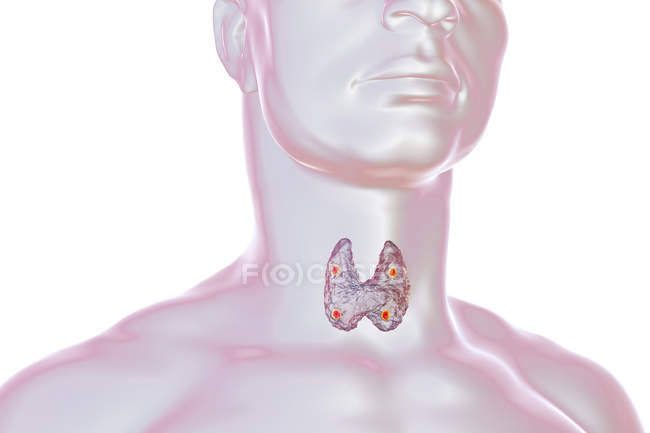 Illustrazione digitale delle ghiandole paratiroidi rosse accentuate situate dietro la ghiandola tiroidea nella silhouette umana . — Foto stock