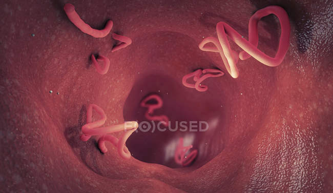 Infestación por tenias en el intestino humano, ilustración digital . - foto de stock