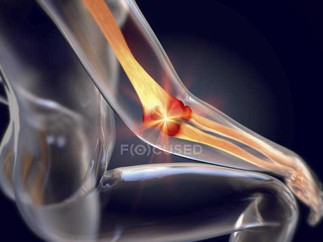 Ilustración 3d de epicondilitis lateral dolorosa articulación del codo de tenista en silueta femenina . - foto de stock