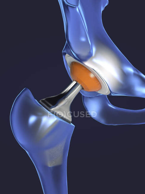 Implants de remplacement de hanche, illustration numérique médicale . — Photo de stock