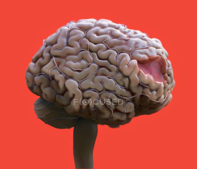 Lésions cérébrales humaines, illustration médicale numérique . — Photo de stock