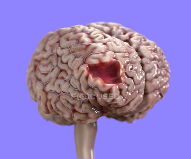 Danni cerebrali umani, illustrazione medica digitale . — Foto stock