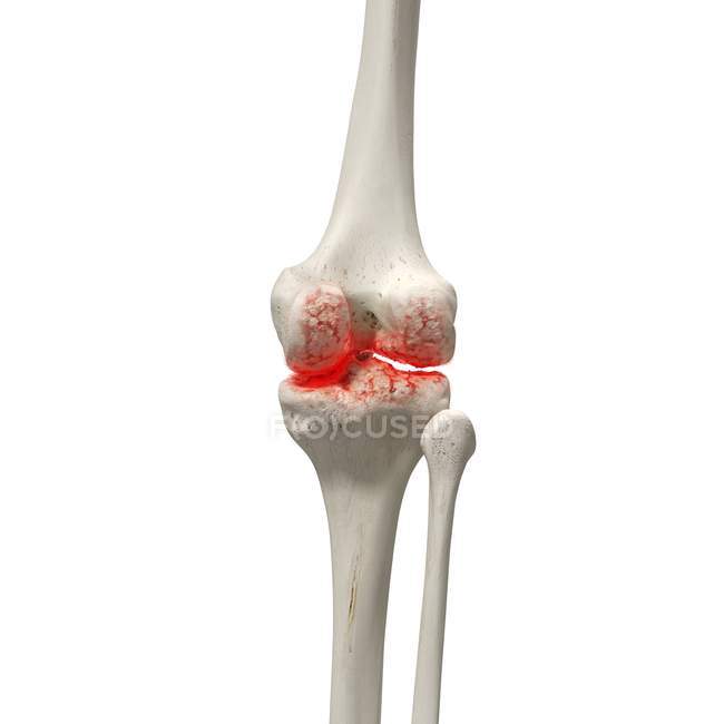 Реалистичная цифровая иллюстрация, показывающая артрит в колене человека . — стоковое фото