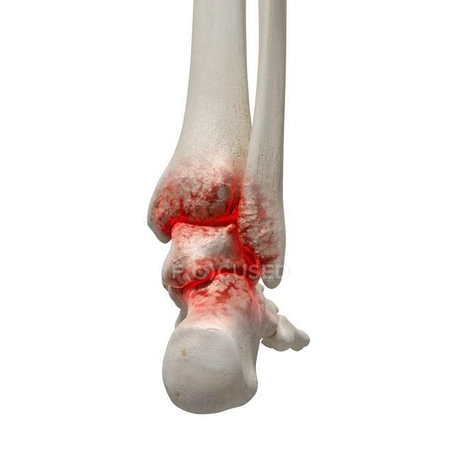 Ilustración digital realista que muestra artritis en el tobillo humano . - foto de stock