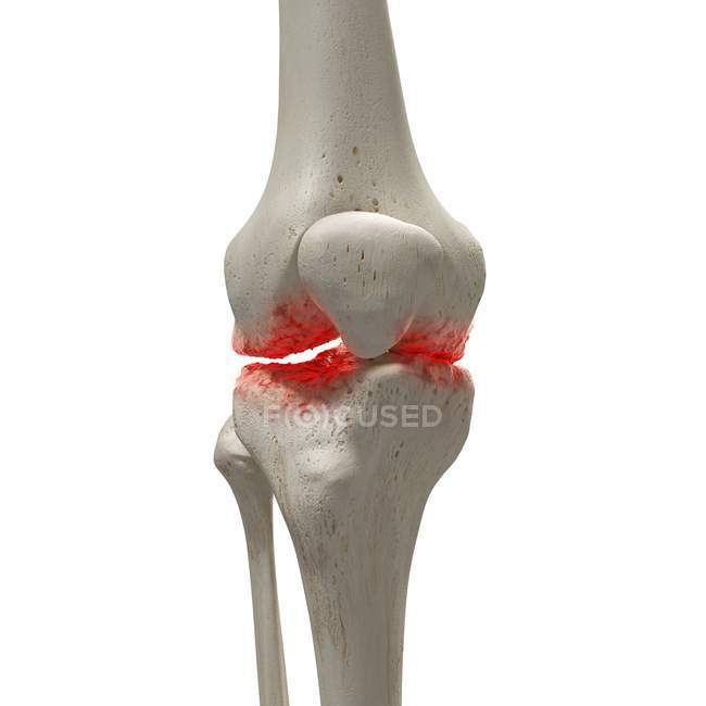 Illustration numérique réaliste montrant l'arthrite dans le genou humain . — Photo de stock