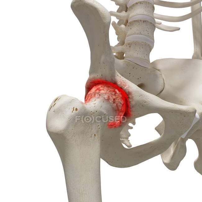 Realistic digital illustration showing arthritis in human hip. — Stock Photo