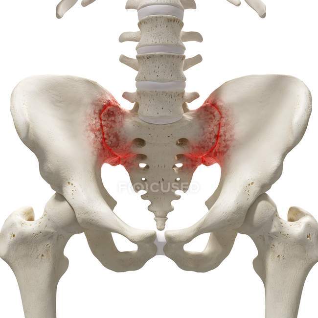 Realistic digital illustration showing arthritis in human sacrum. — Stock Photo