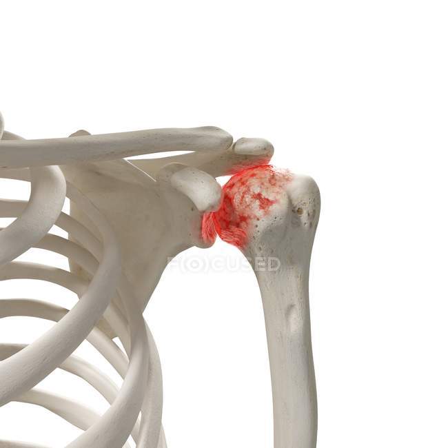 Ilustración digital realista que muestra artritis en el hombro humano
. - foto de stock