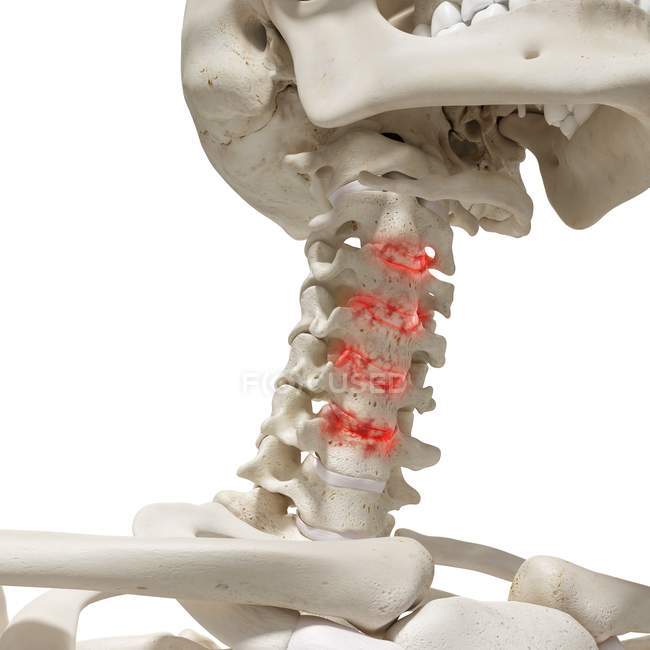 Illustrazione digitale realistica che mostra l'artrite nella colonna vertebrale cervicale umana . — Foto stock