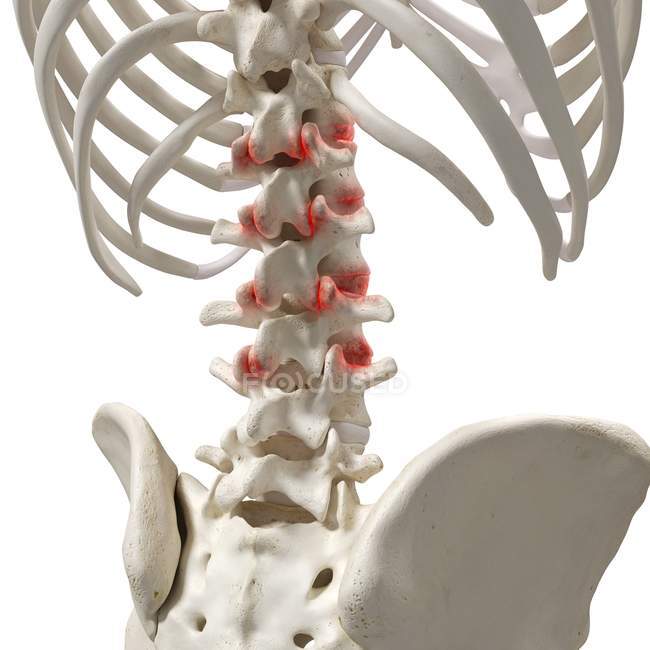 Ilustración digital realista que muestra artritis en la columna vertebral humana . - foto de stock
