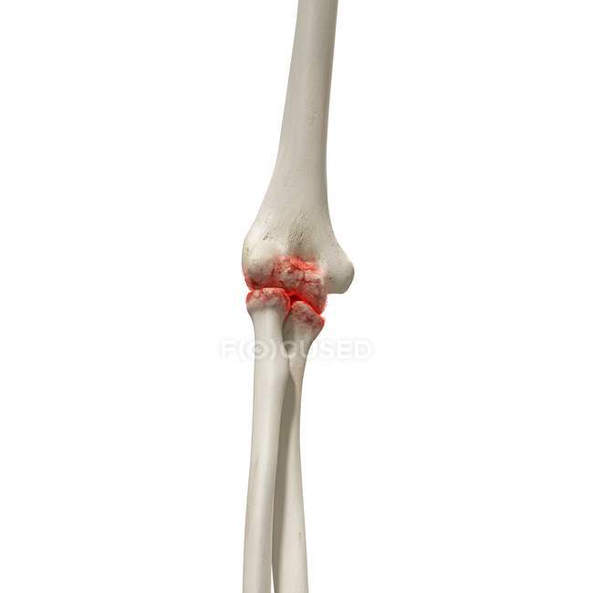 Ilustração digital realista mostrando artrite no cotovelo humano
. — Fotografia de Stock