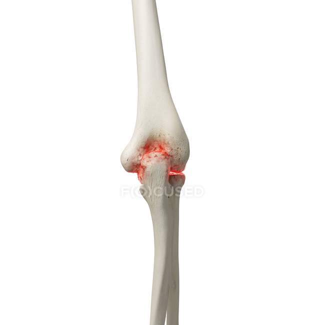 Illustrazione digitale realistica che mostra l'artrite nel gomito umano . — Foto stock
