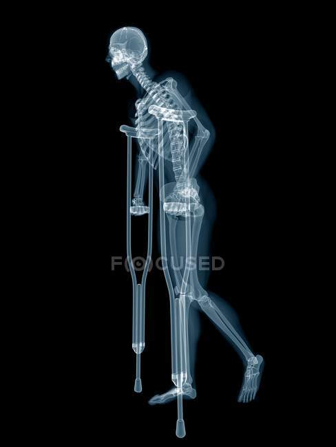 Sistema scheletrico di persona su stampelle, illustrazione digitale . — Foto stock