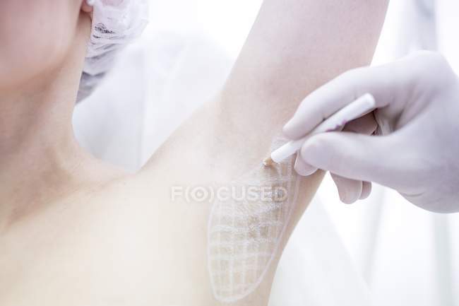 Dermatólogo inyectando botox en axilas femeninas para tratar la sudoración excesiva, primer plano . - foto de stock