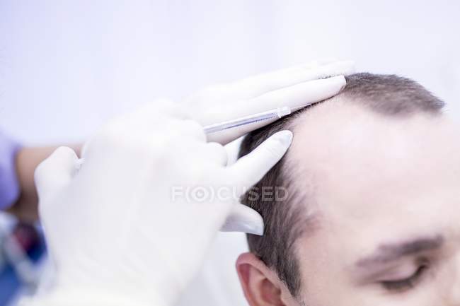Homem jovem com re-aplicação de plasma no couro cabeludo para tratamento de tricologia, close-up . — Fotografia de Stock