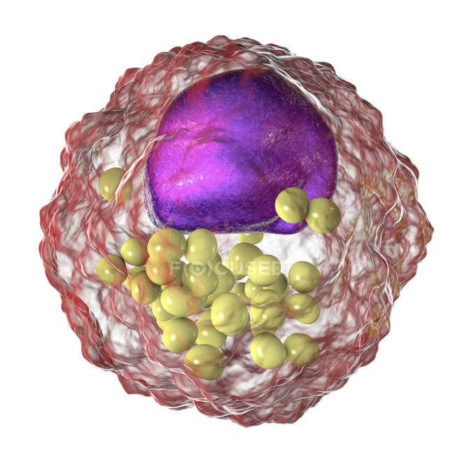 Cellule de mousse macrophagique contenant des gouttelettes lipidiques, illustration numérique . — Photo de stock
