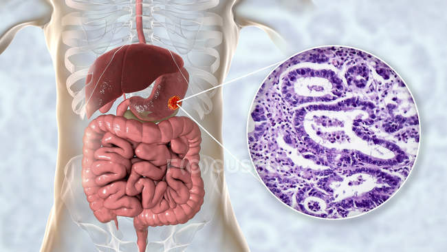 Аденокарцинома желудка человека, компьютерная иллюстрация и световой микрограф
. — стоковое фото