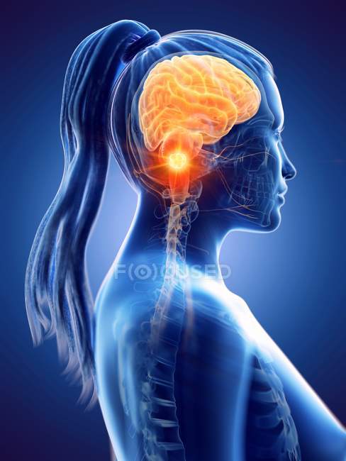 Рак мозку в жіночому тілі, концептуальна комп'ютерна ілюстрація. — стокове фото