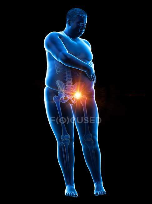Silhouette eines fettleibigen Mannes mit Hüftschmerzen, digitale Illustration. — Stockfoto