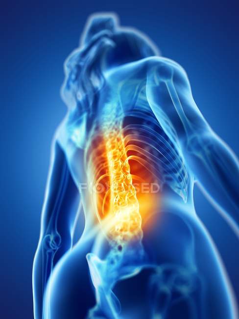 Silhueta do corpo feminino com dor nas costas, ilustração digital conceitual . — Fotografia de Stock