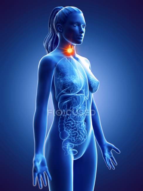Cancro da tireóide no corpo feminino, ilustração conceitual do computador . — Fotografia de Stock