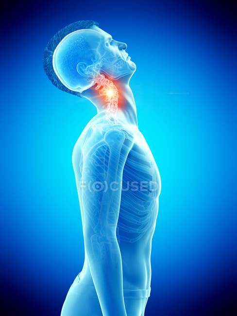 Silhueta humana abstrata com pescoço lesionado com dor, ilustração conceitual . — Fotografia de Stock