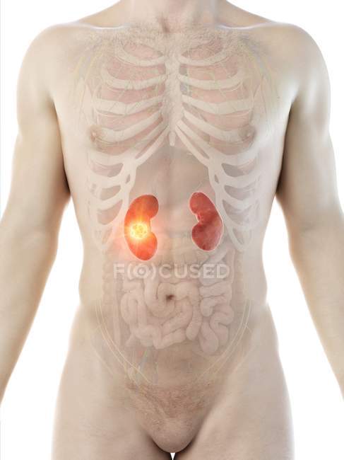 Cancer du rein dans le corps masculin, illustration numérique conceptuelle
. — Photo de stock