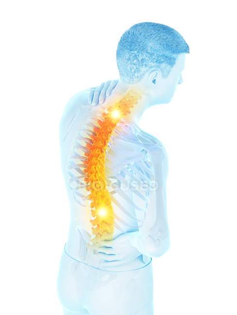 Männliche Silhouette mit Rückenschmerzen im Hochwinkel, konzeptionelle Illustration. — Stockfoto