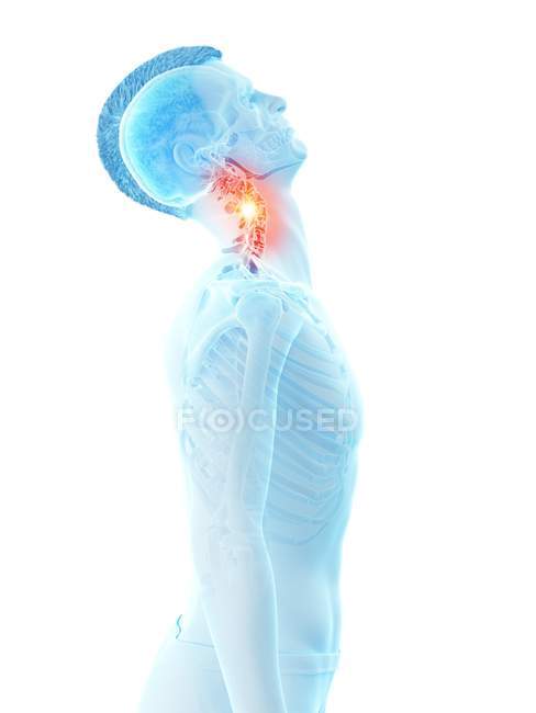 Abstract human silhouette with injured neck with pain, conceptual illustration. — Stock Photo