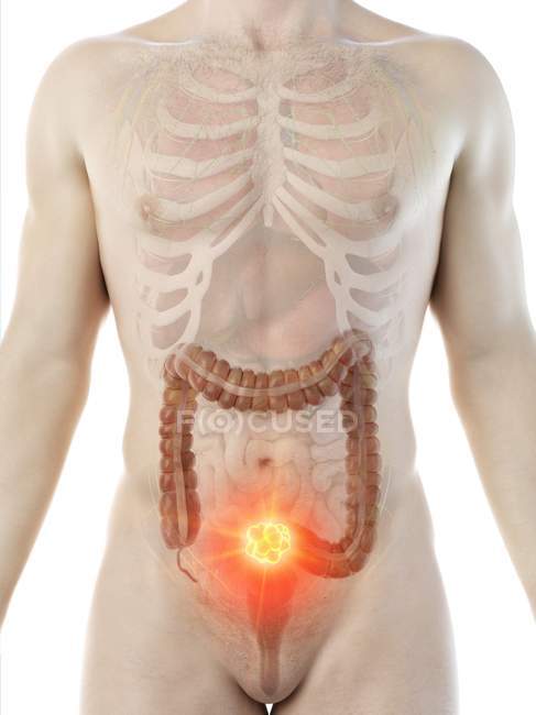 Рак товстої кишки у чоловічому тілі, концептуальна комп'ютерна ілюстрація . — стокове фото