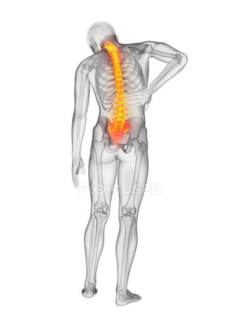 Rear view of male body with inflammation and back pain, conceptual illustration. — Stock Photo