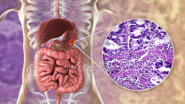 Adénocarcinome de l'estomac humain, illustration par ordinateur et micrographie photonique
. — Photo de stock