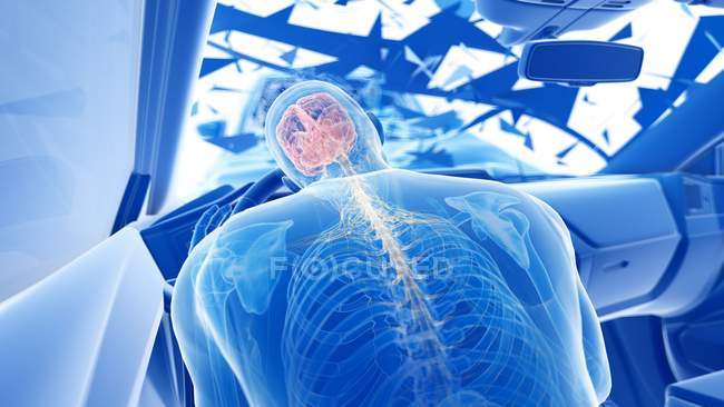Röntgen-Illustration des Risikos von Gehirnverletzungen bei einem Frontalzusammenstoß, digitales Kunstwerk. — Stockfoto