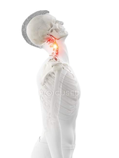 Абстрактный человеческий силуэт с поврежденной шеей с болью, концептуальная иллюстрация . — стоковое фото