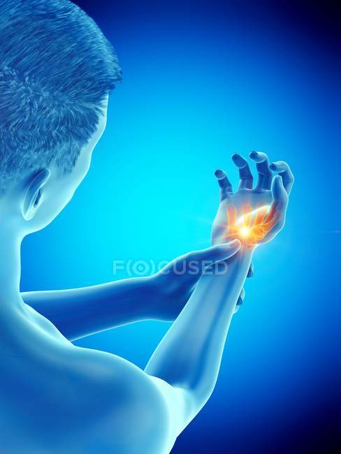 Männlicher Körper mit glühenden Handgelenkschmerzen, konzeptionelle Illustration. — Stockfoto