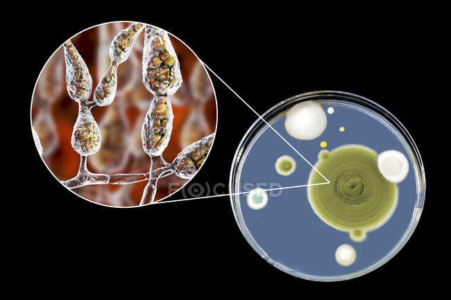 Цифровая иллюстрация грибковой морфологии нитевидного аллергенного гриба Alternaria alternata и фотография грибковых колоний на Sabouraud Dextrose Agar
. — стоковое фото