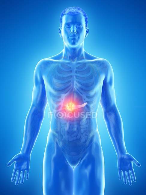 Bauchspeicheldrüsenkrebs im männlichen Körper, konzeptionelle Computerillustration. — Stockfoto