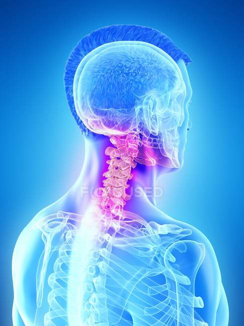 Male silhouette with visible neck pain, conceptual computer illustration. — Stock Photo