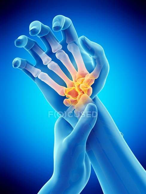 Männlicher Körper mit glühenden Handgelenkschmerzen, konzeptionelle Illustration. — Stockfoto