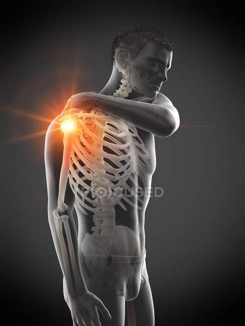 Silueta del hombre con dolor en el hombro, ilustración conceptual
. - foto de stock